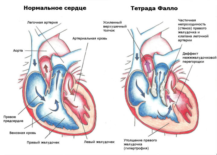 tetrada tr ada pentada fallo u d tey opis uzd oznaki pri vag tnost d agnostika u novonarodzhenih prognoz p slya operac 2 - Тетрада, тріада, пентада Фалло у дітей: опис, УЗД-ознаки при вагітності, діагностика у новонароджених, прогноз після операції