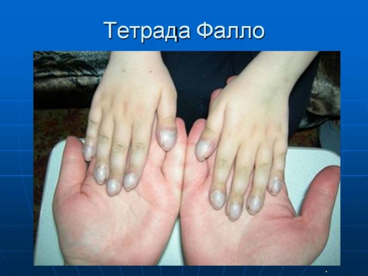 tetrada tr ada pentada fallo u d tey opis uzd oznaki pri vag tnost d agnostika u novonarodzhenih prognoz p slya operac 3 - Тетрада, тріада, пентада Фалло у дітей: опис, УЗД-ознаки при вагітності, діагностика у новонароджених, прогноз після операції