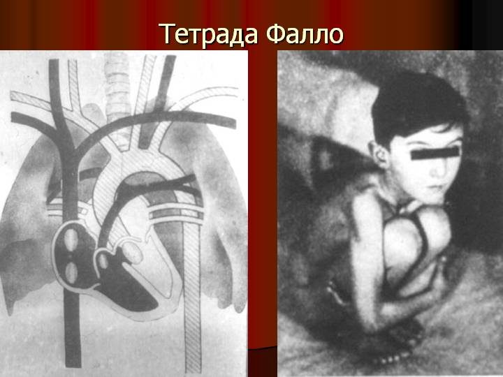 tetrada tr ada pentada fallo u d tey opis uzd oznaki pri vag tnost d agnostika u novonarodzhenih prognoz p slya operac 4 - Тетрада, тріада, пентада Фалло у дітей: опис, УЗД-ознаки при вагітності, діагностика у новонароджених, прогноз після операції
