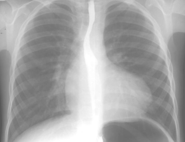 tetrada tr ada pentada fallo u d tey opis uzd oznaki pri vag tnost d agnostika u novonarodzhenih prognoz p slya operac 5 - Тетрада, тріада, пентада Фалло у дітей: опис, УЗД-ознаки при вагітності, діагностика у новонароджених, прогноз після операції