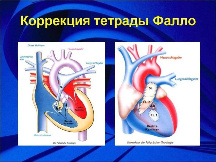 tetrada tr ada pentada fallo u d tey opis uzd oznaki pri vag tnost d agnostika u novonarodzhenih prognoz p slya operac 8 - Тетрада, тріада, пентада Фалло у дітей: опис, УЗД-ознаки при вагітності, діагностика у новонароджених, прогноз після операції