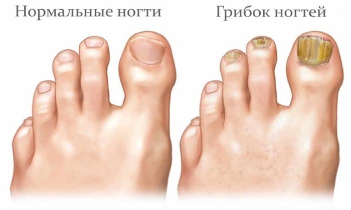 ТРАВОГЕН – інструкція із застосування, ціна, відгуки і аналоги travogen nstrukc ya z zastosuvannya c na v dguki analogi 3 - ТРАВОГЕН – інструкція із застосування, ціна, відгуки і аналоги