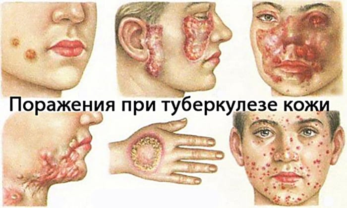 ТРИДЕРМ або АКРИДЕРМ: що краще і в чому різниця (відмінність складів, відгуки лікарів) triderm abo akriderm scho krasche v chomu r znicya v dm nn st sklad v v dguki l kar v 10 - ТРИДЕРМ або АКРИДЕРМ: що краще і в чому різниця (відмінність складів, відгуки лікарів)