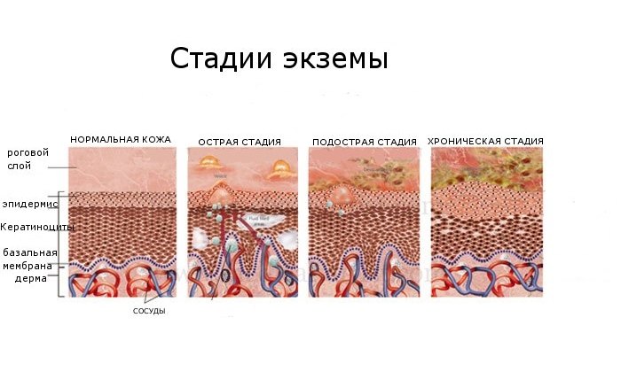 ТРИДЕРМ або АКРИДЕРМ: що краще і в чому різниця (відмінність складів, відгуки лікарів) triderm abo akriderm scho krasche v chomu r znicya v dm nn st sklad v v dguki l kar v 5 - ТРИДЕРМ або АКРИДЕРМ: що краще і в чому різниця (відмінність складів, відгуки лікарів)