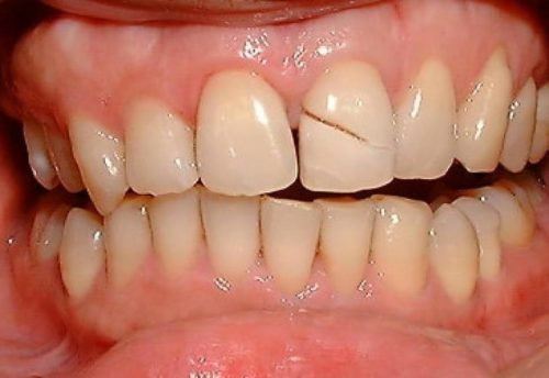 v dkololasya emal na zub r znovidi skol v sposobi v dnovlennya 3 - Відкололася емаль на зубі: різновиди сколів, способи відновлення