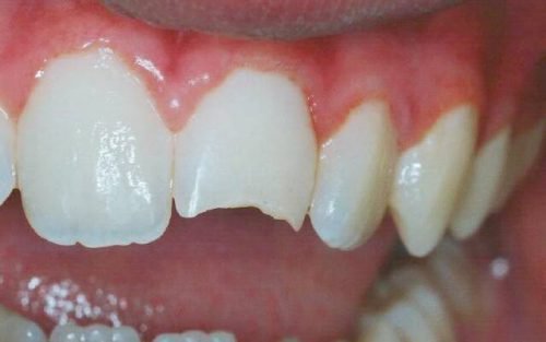 v dkololasya emal na zub r znovidi skol v sposobi v dnovlennya 4 - Відкололася емаль на зубі: різновиди сколів, способи відновлення