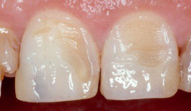v dkololasya emal na zub r znovidi skol v sposobi v dnovlennya 5 - Відкололася емаль на зубі: різновиди сколів, способи відновлення
