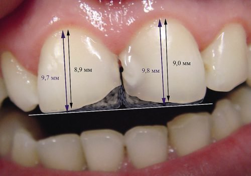 v dkololasya emal na zub r znovidi skol v sposobi v dnovlennya 6 - Відкололася емаль на зубі: різновиди сколів, способи відновлення