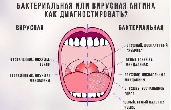 v rusna ang na u d tey vidi gerpetichna fol kulyarna lakunarna ta nsh prichini viniknennya simptomi d agnostika l kuvannya ta prof laktika foto 2 - Вірусна ангіна у дітей: види (герпетична, фолікулярна, лакунарна та інші), причини виникнення, симптоми, діагностика, лікування та профілактика + фото