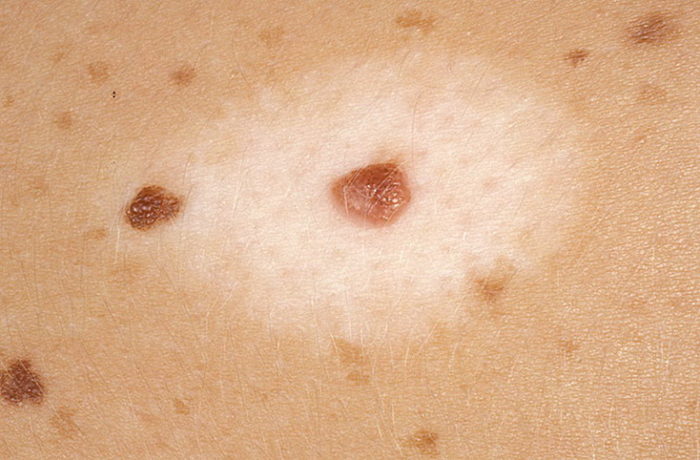 v t l go abo nevus setona u ditini u yakomu vipadku mozhlive neobh dne l kuvannya 2 - Вітіліго або невус Сетона у дитини: у якому випадку можливе і необхідне лікування