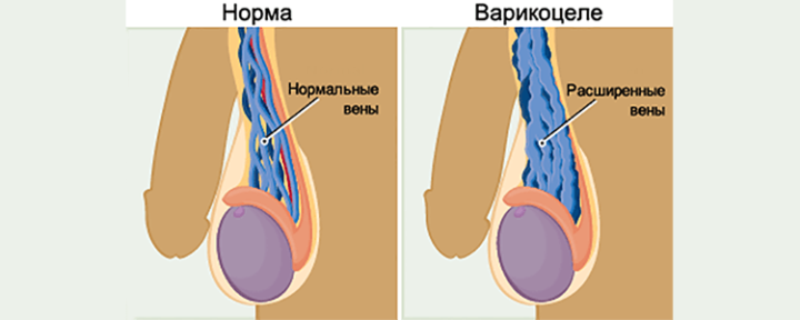 varikocele u d tey v tomu chisl p dl tk v osoblivost varikozu ya chok u hlopchik v 2 - Варикоцеле у дітей, в тому числі підлітків, особливості варикозу яєчок у хлопчиків