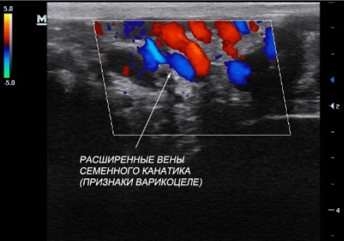 varikocele u d tey v tomu chisl p dl tk v osoblivost varikozu ya chok u hlopchik v 7 - Варикоцеле у дітей, в тому числі підлітків, особливості варикозу яєчок у хлопчиків
