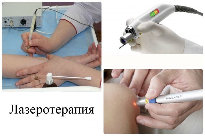 vidalennya borodavok lazerom pokazannya ta protipokazannya proces nasl dki vidalennya borodavok d tyam foto v deo 4 - Видалення бородавок лазером: показання та протипоказання, процес, наслідки, видалення бородавок дітям, фото і відео