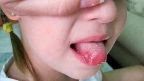virazki na yazic u ditini prichini l kuvannya zahvoryuvan porozhnini rota 1 - Виразки на язиці у дитини: причини, лікування захворювань порожнини рота