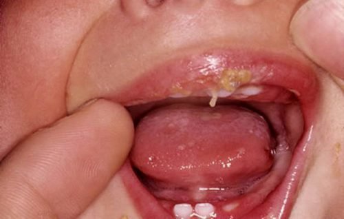virazki na yazic u ditini prichini l kuvannya zahvoryuvan porozhnini rota 4 - Виразки на язиці у дитини: причини, лікування захворювань порожнини рота
