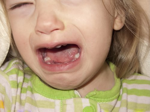 virazki na yazic u ditini prichini l kuvannya zahvoryuvan porozhnini rota 5 - Виразки на язиці у дитини: причини, лікування захворювань порожнини рота