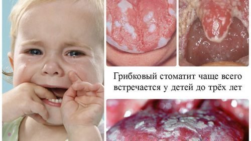 virazki na yazic u ditini prichini l kuvannya zahvoryuvan porozhnini rota 8 - Виразки на язиці у дитини: причини, лікування захворювань порожнини рота