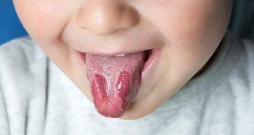 virazki na yazic u ditini prichini l kuvannya zahvoryuvan porozhnini rota 9 - Виразки на язиці у дитини: причини, лікування захворювань порожнини рота