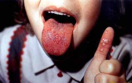 visip na mov b liy nal t chervoniy yazik alergiya prichini 4 - Висип на мові: білий наліт, червоний язик, алергия, причини