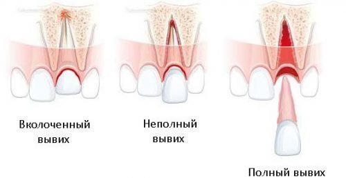vivih zuba vkolocheniy simptomi prichini l kuvannya nebezpeka travm 1 - Вивих зуба вколочений: симптоми, причини, лікування, небезпека травм