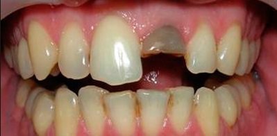 vivih zuba vkolocheniy simptomi prichini l kuvannya nebezpeka travm 4 - Вивих зуба вколочений: симптоми, причини, лікування, небезпека травм