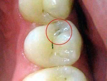 vnutr shn y kar s zuba prichini d agnostika v chomu nebezpeka prof laktika 3 - Внутрішній карієс зуба: причини, діагностика, в чому небезпека, профілактика