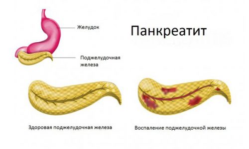 Як болить підшлункова у людини – що робити, симптоми, лікування, дієта, перші ознаки yak bolit p dshlunkova u lyudini scho robiti simptomi l kuvannya d ta persh oznaki 4 - Як болить підшлункова у людини – що робити, симптоми, лікування, дієта, перші ознаки
