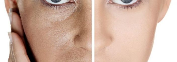 Як боротися з розширеними порами на обличчі: огляд косметичних засобів, салонних процедур, домашніх масок, відгуки і відео
