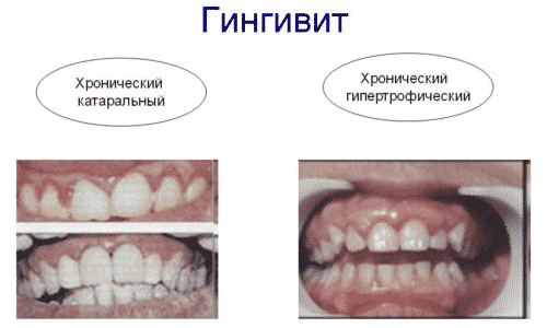 ЙОДДИЦЕРИН – інструкція із застосування, ціна, відгуки і аналоги yoddicerin nstrukc ya z zastosuvannya c na v dguki analogi 5 - ЙОДДИЦЕРИН – інструкція із застосування, ціна, відгуки і аналоги