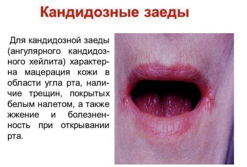 za di na gubah prichini yak l kuvati tr skayut sya kutochki gub 3 - Заїди на губах: причини, як лікувати, тріскаються куточки губ