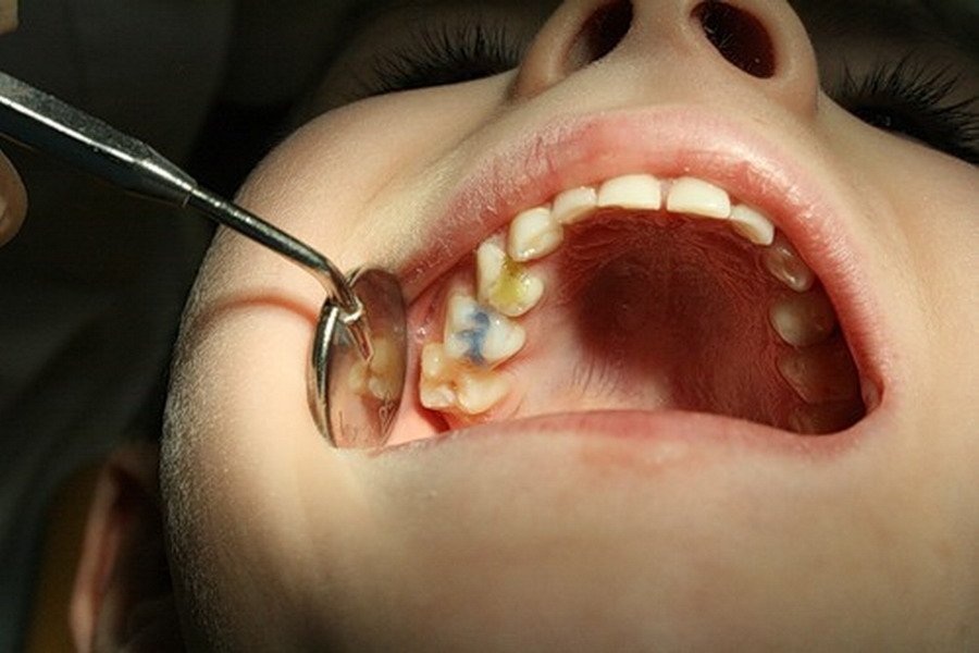 zahvoryuvannya molochnih zub v ta metodi l kuvannya kar su per ostitu pul p tu u d tey 1 - Захворювання молочних зубів та методи лікування карієсу, періоститу і пульпіту у дітей