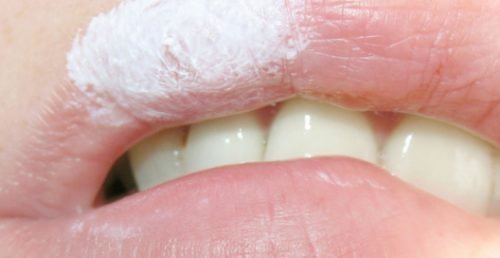 Зубна паста від герпесу на губах: чи можна, швидке лікування в домашніх умовах