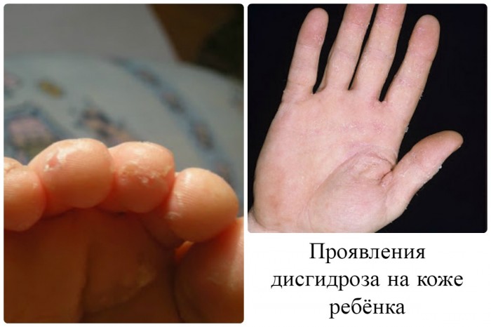 Дисгідрозі кистей рук і стоп у дітей: симптоми, лікування, профілактика, фото