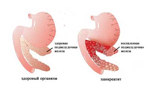 Капуста при панкреатиті: шкода і користь, безпечні сорту і способи приготування