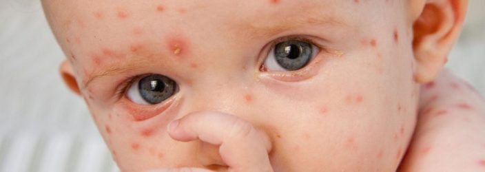Профілактика вітряної віспи у дорослих та дітей: як можна заразитися, інкубаційний період і заразність захворювання