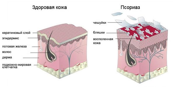 Шкіра на ступні лущиться і свербить – причини, що робити